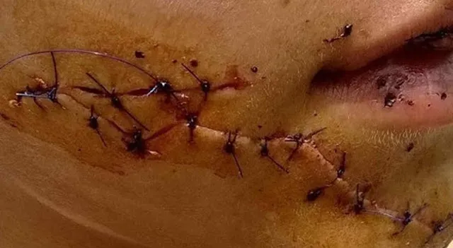 Adolescente é atacada com facadas por vizinhas na Argentina