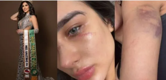 Miss Manaus Denuncia Violência Doméstica e Aparece Cheia de Hematomas: “Me Deu Murros”