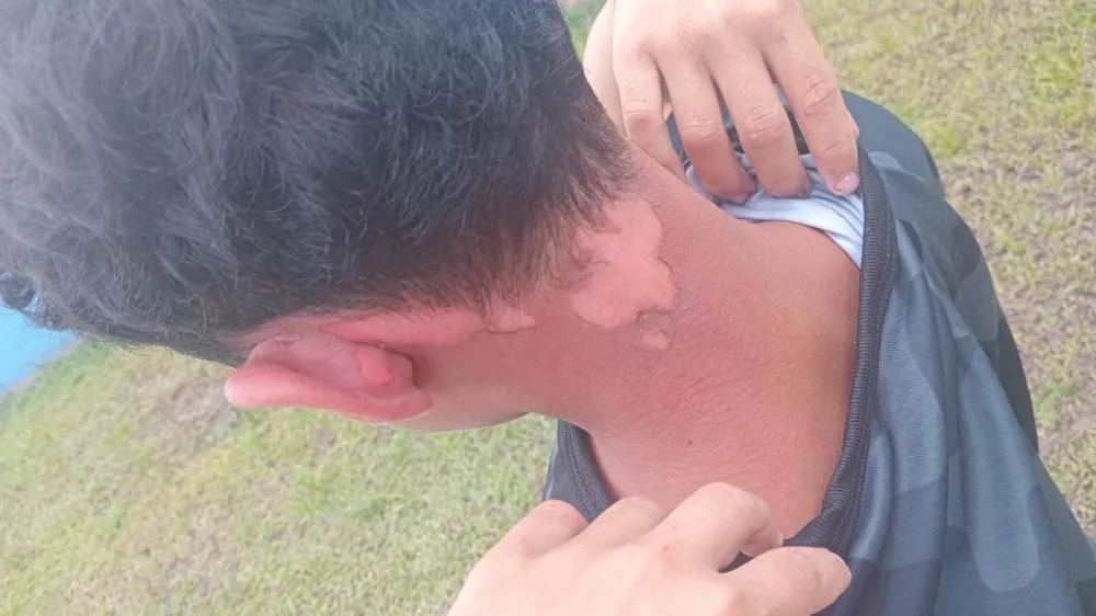 Criança de 9 anos sofre queimaduras graves após vizinha jogar água fervente no interior do AM